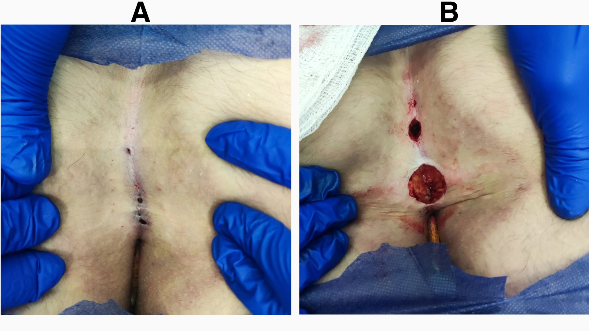 Figure 1. (A) Preoperative view of the sacrococcygeal region showing a chronic pilonidal sinus within the natal cleft, with multiple epithelialized midline pits visible. (B) Immediate postoperative view following excision, with the sinus tracts completely removed and wounds left open for healing by secondary intention.