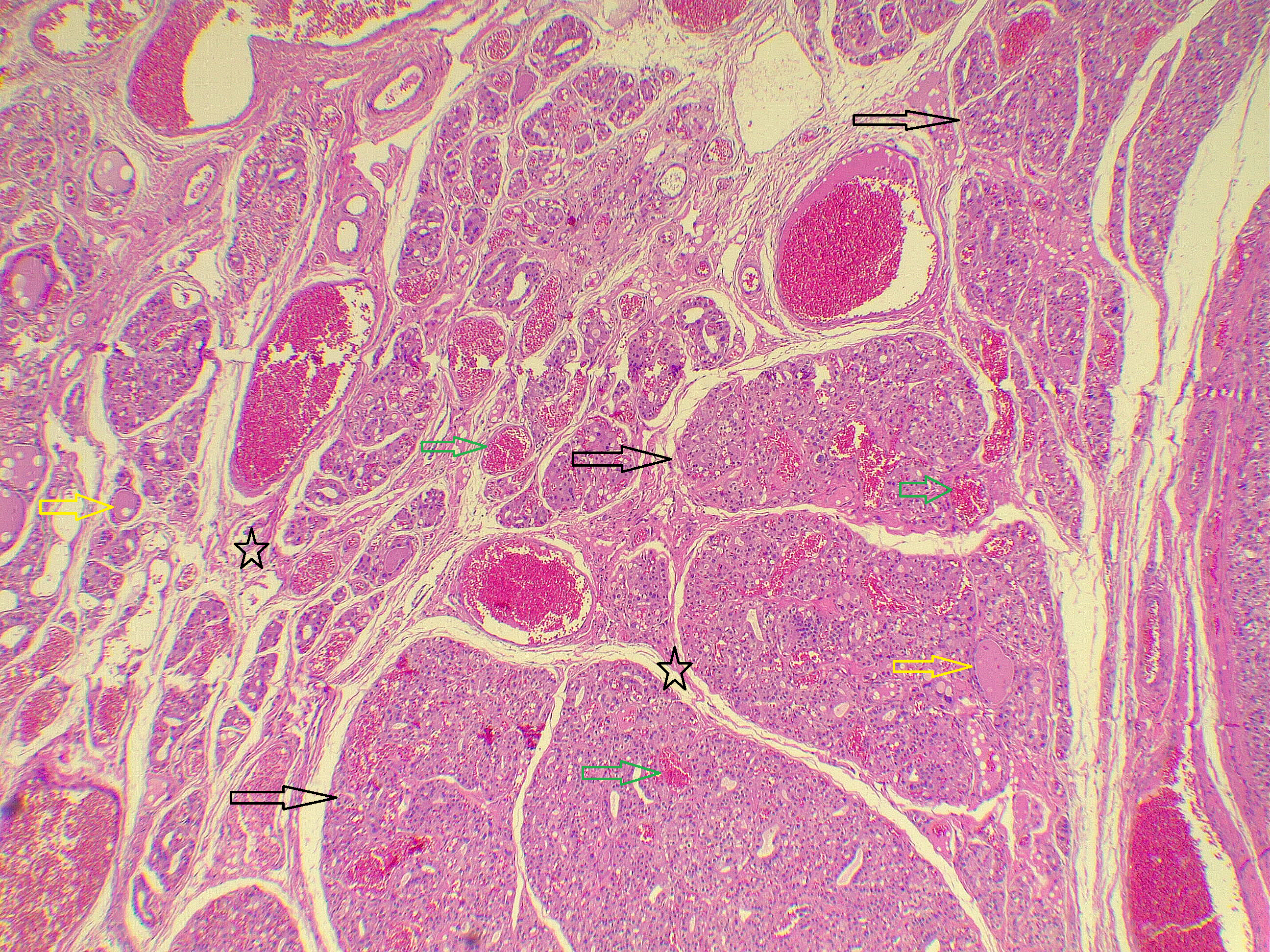 Figure 1. The section shows nodules of thyroid follicles (dark arrows), most of them composed of empty follicles, while a few others contain little colloid material (yellow arrows) and are separated by fibrous bands (dark stars), with the presence of numerous different-sized vascular proliferations (green arrows). Hematoxylin and Eosin stain 10X .