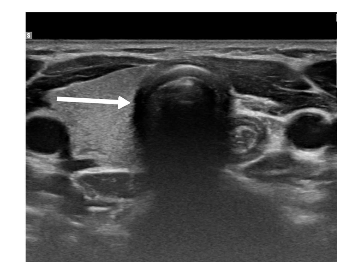 Figure 1. Ultrasound findings of the thyroid gland demonstrate a right lobe of normal size (53 × 16 × 14 mm) with homogeneous parenchymal echotexture and no evidence of focal lesions. Notably, there is agenesis of the isthmus and absence of the left thyroid lobe (indicated by white arrow), consistent with thyroid hemiagenesis.