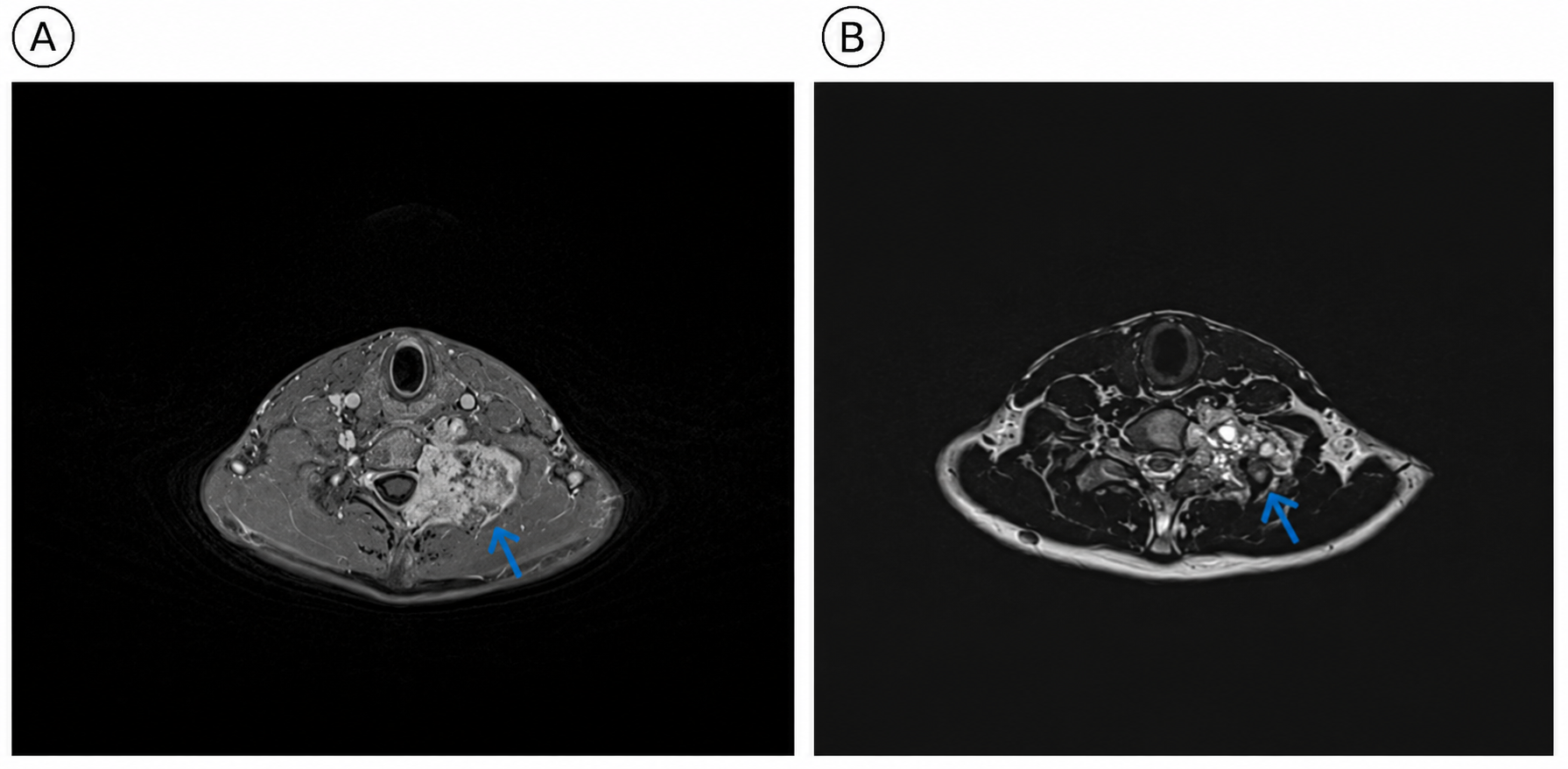 Figure 1. MRI of the cervical spine with IV gadolinium (A) and T2WI (B) revealed a well-defined expansile vertebral mass involving part of the vertebral body and left-sided posterior vertebral elements (Blue arrow), showing a T2 intermediate-signal-intensity solid enhancing component peripherally and a multiloculated central cystic change.