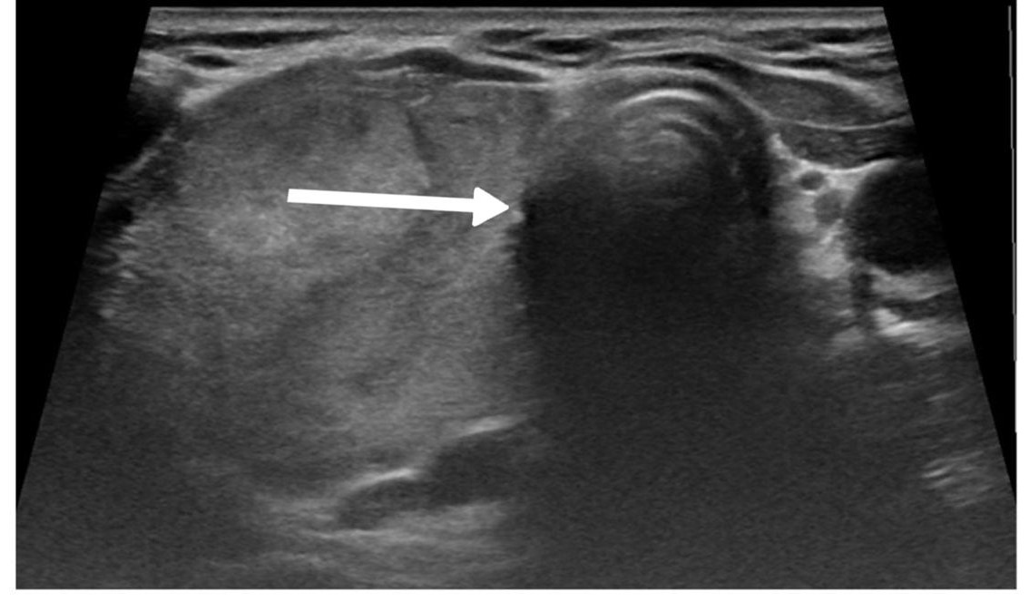 Figure 2. Ultrasound findings of the thyroid gland reveal a mildly enlarged left lobe measuring 57 × 20 × 19 mm, exhibiting heterogeneous parenchymal echogenicity. Multiple solid isoechoic nodules are present, the largest measuring 20 × 16 × 14 mm and classified as TIRADS 3. The right lobe and isthmus are absent (indicated by white arrow), consistent with right thyroid hemiagenesis.
