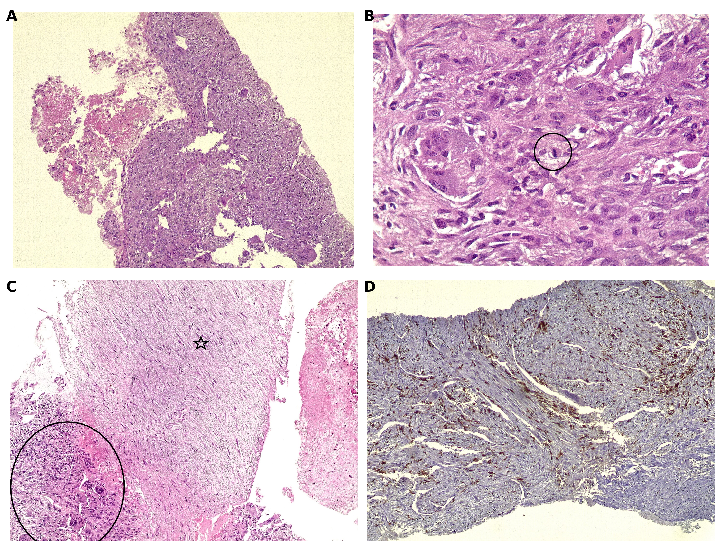 Figure 2. Microscopic findings in the left transverse process core biopsies: A) Aneurysmal bone cyst-like changes showing variably sized vascular spaces with unevenly distributed giant cells in fibroblastic stroma, H&E x100. B) Giant cells with mitosis (in the circle), H&E x400. C) Myxoid area (star) rimmed by giant cells (in the circle), H&E x100. D) S100 stain may support the chondroid differentiation of stromal cells, IHC x100.