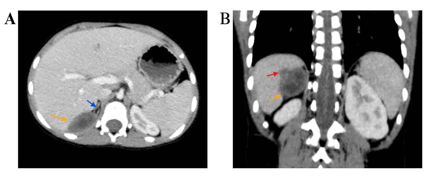 Figure 1. Contrast-enhanced CT scan of the abdomen in axial (A) and coronal (B) views demonstrates a well-defined heterogeneous mass with cystic components (yellow arrow) adjacent to the right adrenal gland (blue arrow), exhibiting focal invasion of hepatic segment VII (red arrow). The mass is in contact with the right hemidiaphragm without definitive evidence of diaphragmatic invasion.