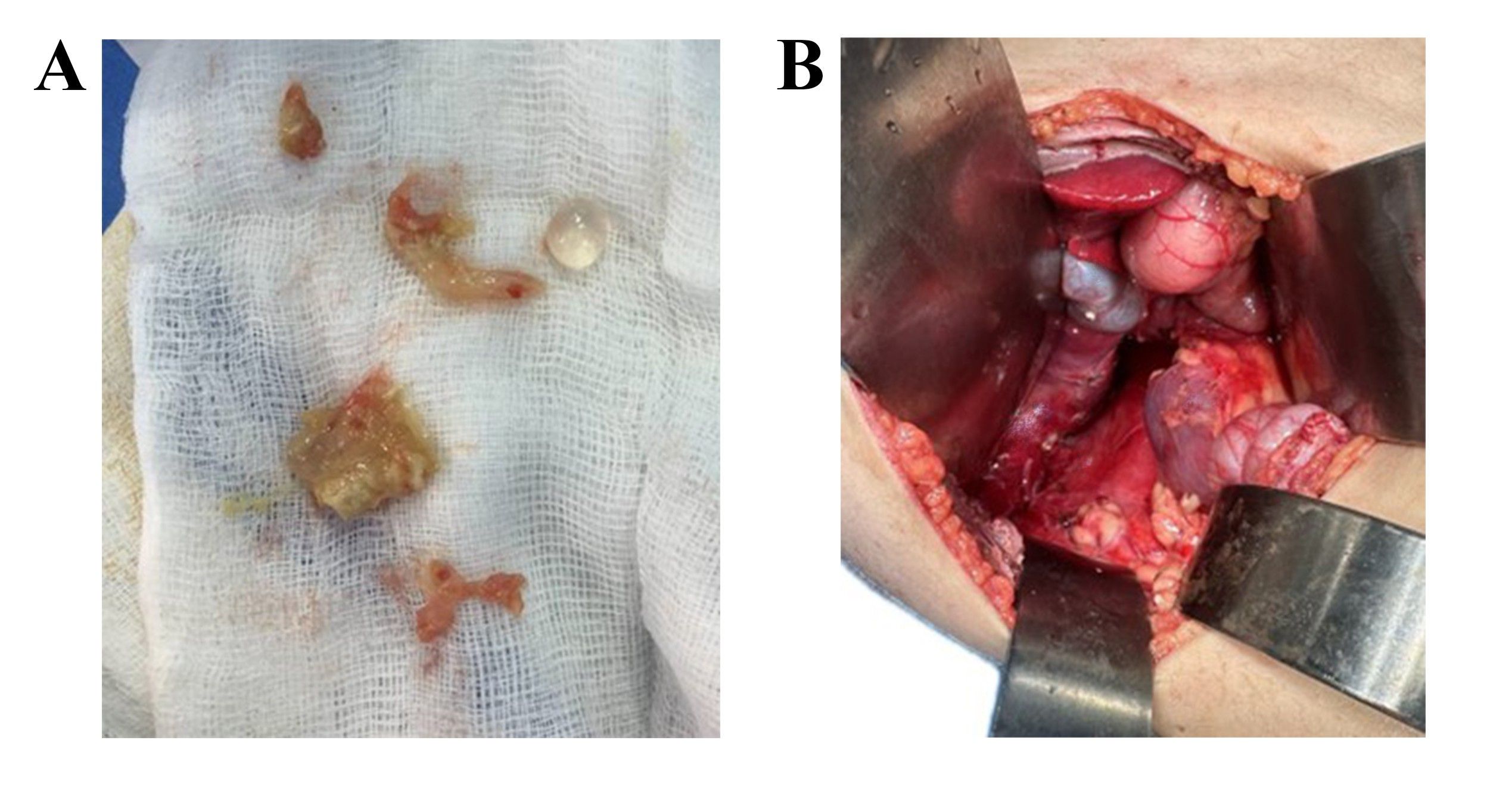 Figure 2. A) Intra-operative findings show three distinct layers of hydatid cyst and multiple ipsilateral lymph nodes. B) The surgical site after resection of the mass includes the liver, kidney, inferior vena cava, bowel, and the inflamed area around the surgical field.