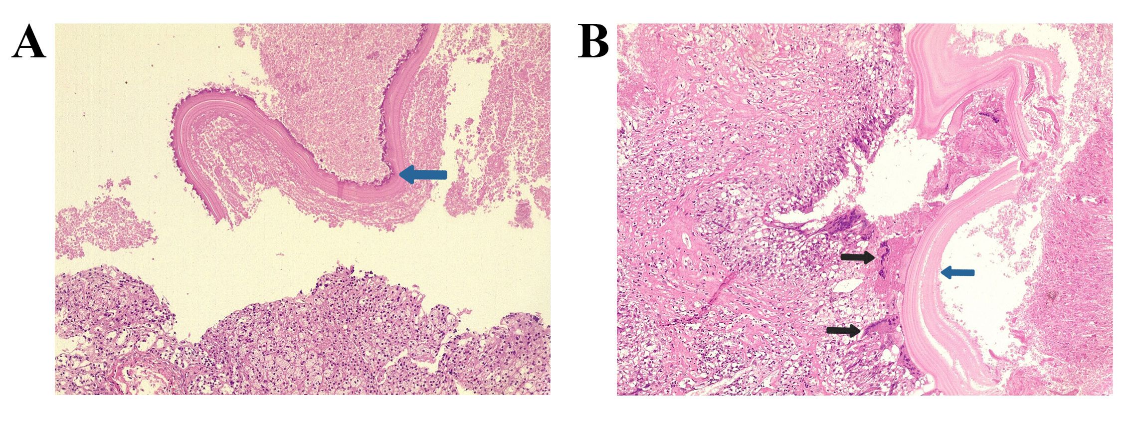 Figure 3. A) The upper part shows a lamellated wall of hydatid cyst (blue arrow) with cellular debris, and the lower part shows the adrenal cortex (H&E x100). B) Section shows lamellated wall of hydatid cyst (blue arrow) with chronic inflammation and foreign body giant cell reaction (black arrows) (H&E x100).