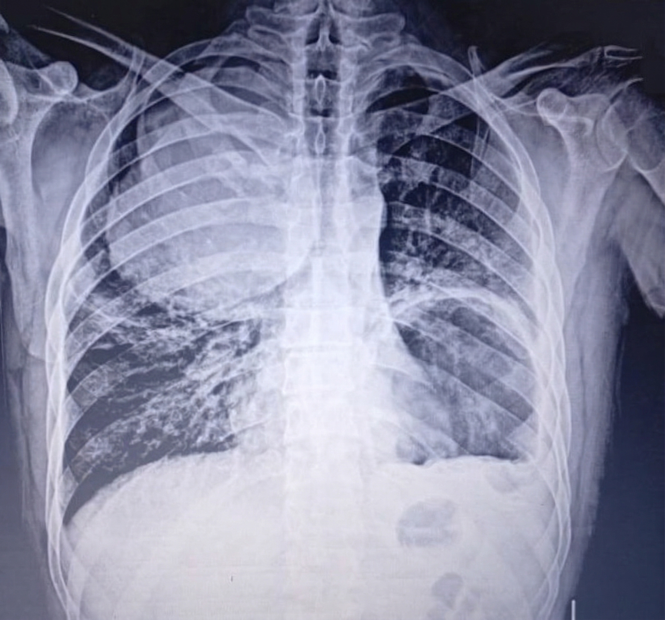 Figure 1. Pre-operative Chest X-ray (PA view) demonstrating a massive radiopaque density in the right upper hemithorax and a large cavitary lesion in the left lower hemithorax.