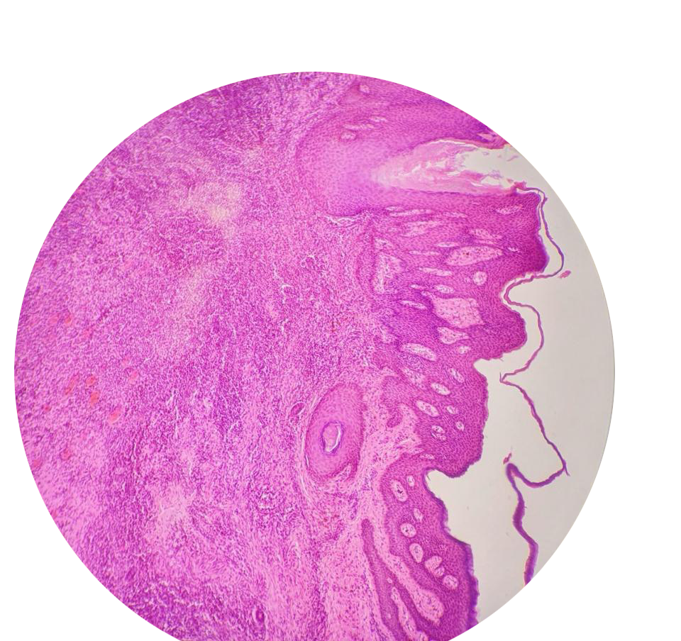 Figure 1. Histopathological examination of the intermammary pilonidal sinus shows fragments of a skin ellipse with focal surface ulceration. The underlying dermis contained a sinus tract surrounded by a dense mixed inflammatory infiltrate, predominantly composed of plasma cells and neutrophils. Granulation tissue formation was also noted around the tract.