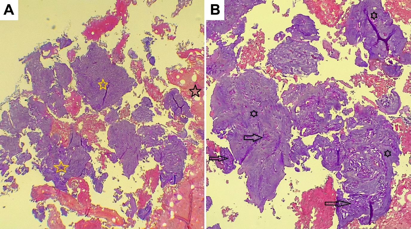 Figure 1. Cytological features of a parotid gland nodule. (A) Low-power view (Hematoxylin and Eosin, ×4) showing hemorrhagic material (dark stars) admixed with cellular elements (yellow stars). (B) Higher-power view of the same area (Hematoxylin and Eosin, ×10) demonstrating bland-appearing epithelial and myoepithelial cells arranged in small groups and as single cells with plasmacytoid features (dark arrows) within a myxoid stroma (dark stars). These cytomorphological features are consistent with pleomorphic adenoma of the parotid gland.