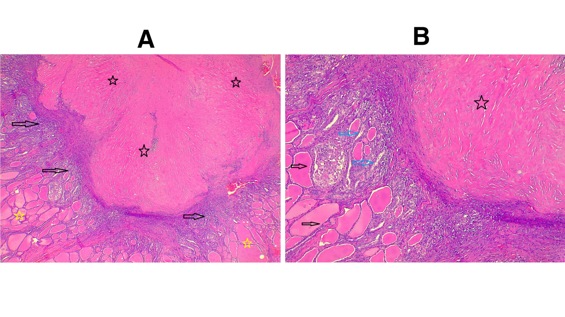 Figure 1. (A) Section shows nodule with central fibrous hypocellular area (dark stars) with presence of adjacent benign thyroid follicles (yellow stars) with the interface of the nodule with thyroid tissue showing more compact follicles with inflammatory cells (dark arrows). Hematoxylin and Eosin stain. 4X (B) Higher power view of the same area showing central fibrosis (dark star) with benign thyroid follicles filled with colloid material (dark arrows), and in between both there are smaller size follicles showing some nuclear clearing and inflammatory cell infiltration (blue arrows). Hematoxylin and Eosin stain. 10X