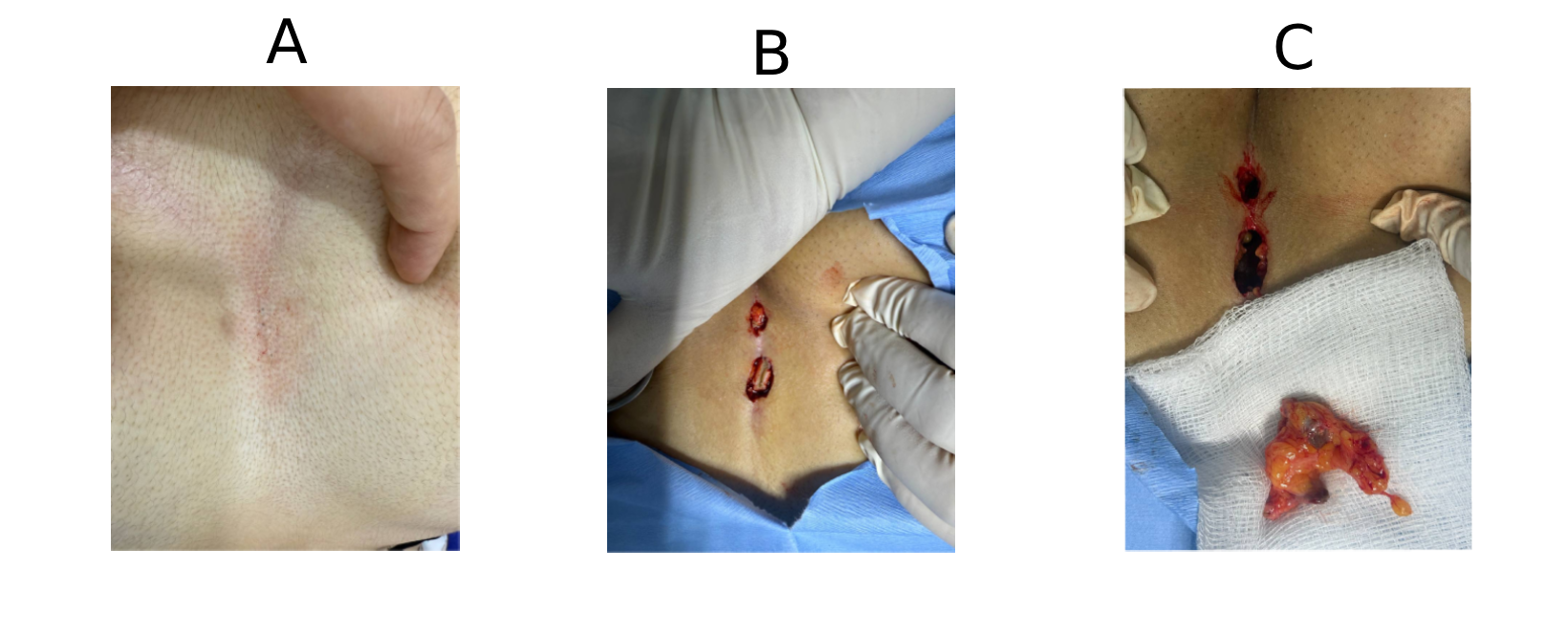 Figure 2. Intermammary pilonidal sinus - preoperative view showing a midline skin indentation with mild erythema over the lesion site (A); intraoperative views demonstrating elliptical skin incisions with exposed sinus tracts (B); and the excised fibrofatty tissue containing sinus material from the intermammary region (C).