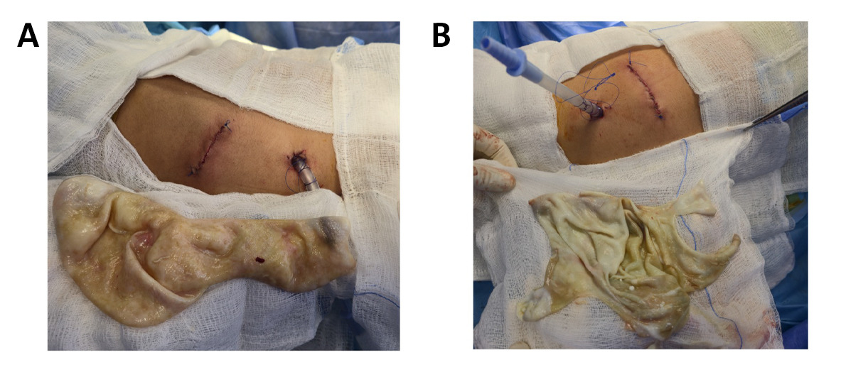 Figure 3. Intra-operative images. (A) View of the right hemithorax showing the bi-port access sites and the large, intact germinal membrane extracted from the uncomplicated giant cyst. (B) View of the left hemithorax showing the trocar placement and the extracted, fragmented, thickened membranes from the ruptured, infected cyst.