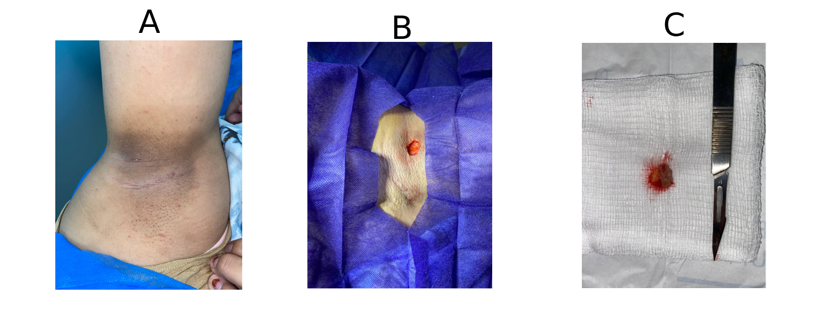 Figure 1. Preoperative image demonstrating a localized indurated area with post-inflammatory hyperpigmentation in the right axillary region (A); intraoperative view showing sinus tract exposure through a limited incision (B); and the excised specimen revealing hair-containing fibrofatty tissue characteristic of pilonidal material (C). 