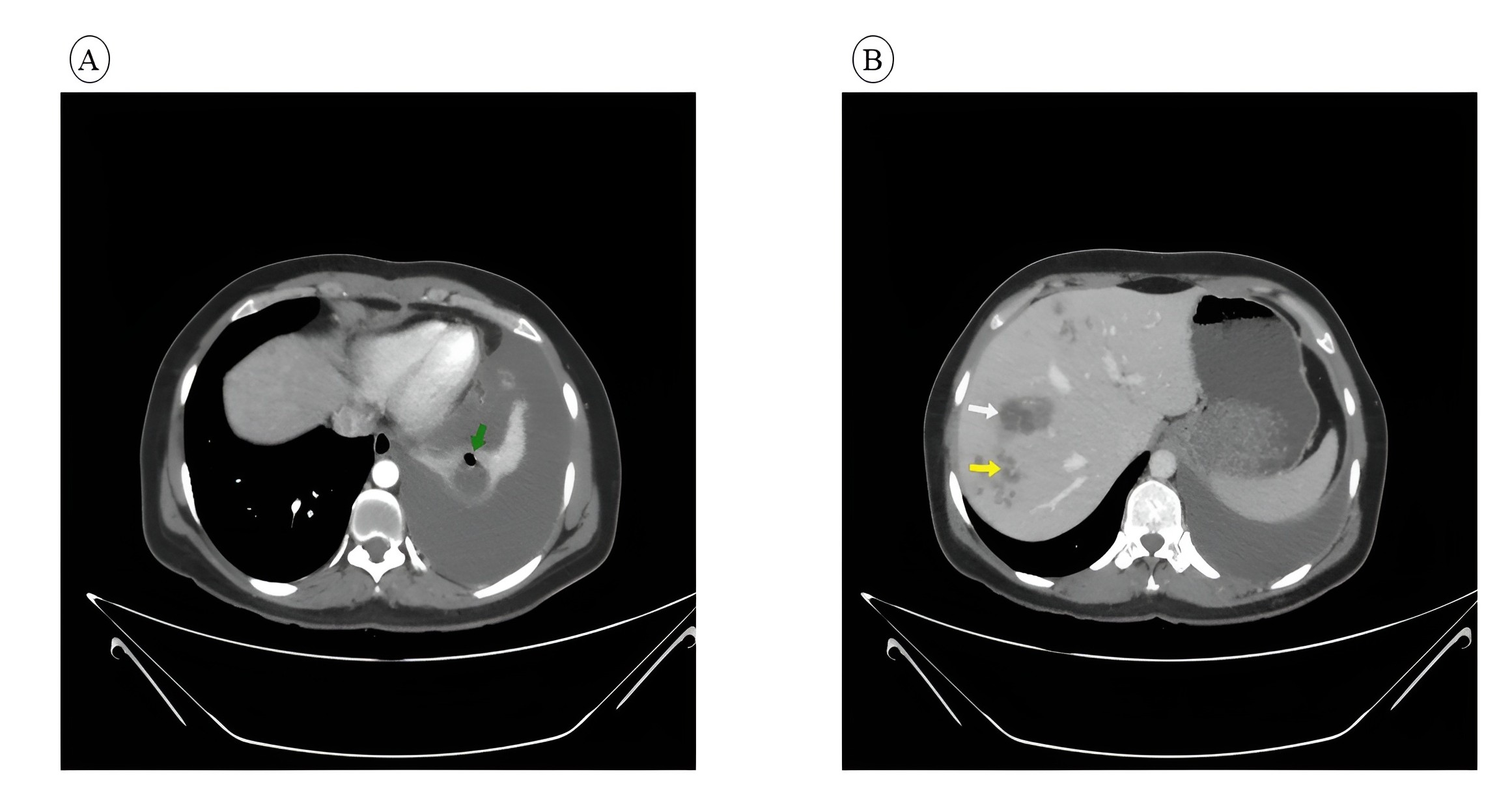 Figure 1. A) Chest CT scan with IV (intravenous) contrast axial section cavity with air bubble “green arrow” inside collapsed basal segments of left lower lobe, associated with marked left pleural effusion, suggesting lung abscess with possible rupture to pleural cavity B) Abdominal CT with IV contrast axial section, showing intrahepatic loculated collection “white arrow”, tortuous linear hypodensities “yellow arrow” which is migrating fasciola inside liver parenchyma known as furrow sign.