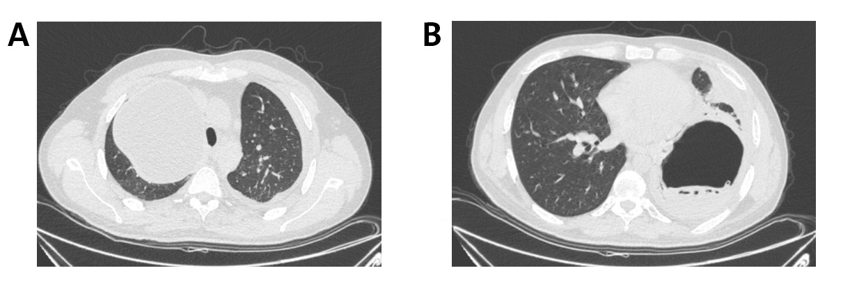 Figure 2. Contrast-enhanced CT chest (axial view). (A) Right upper lobe giant uncomplicated hydatid cyst causing compression of adjacent lung parenchyma. (B) Left lower lobe ruptured cyst showing air-fluid level and detached floating membranes ("water-lily sign").